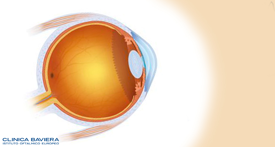 glaucoma