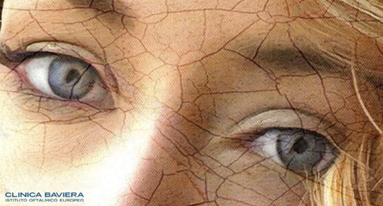 Strabismo di Venere: sintomi e cause - Blog di Clinica Baviera Italia