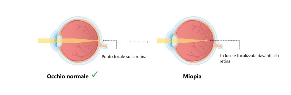 Occhio normale e occhio con miopia