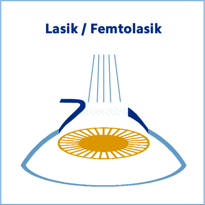 lasik / femtolasik