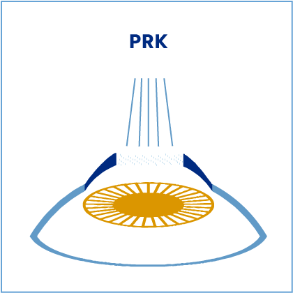 Prk - Chirurgia refrattiva