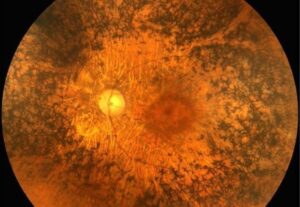 Retinite pigmentosa: che cos'è?