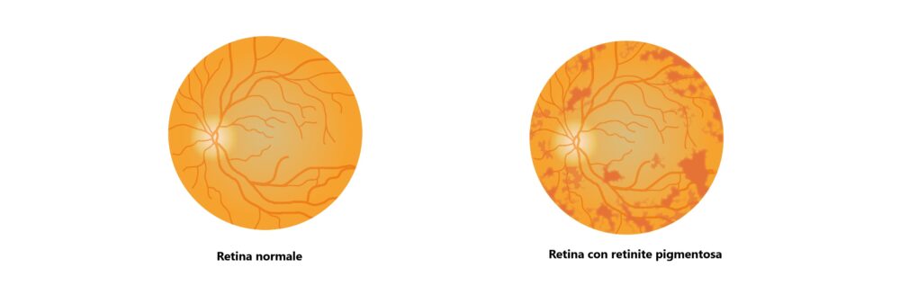 Occhio normale e occhio con retinite pigmentosa