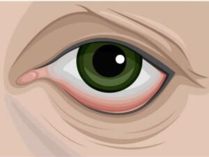 Ectropion palpebrale: che cos'è e come appare?