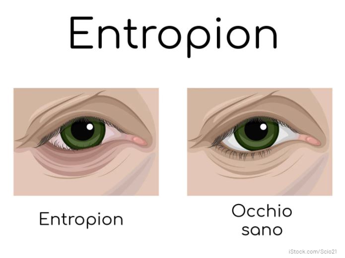 entropion palpebrale