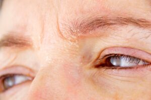 Dermatite palpebrale: cause, sintomi e trattamenti