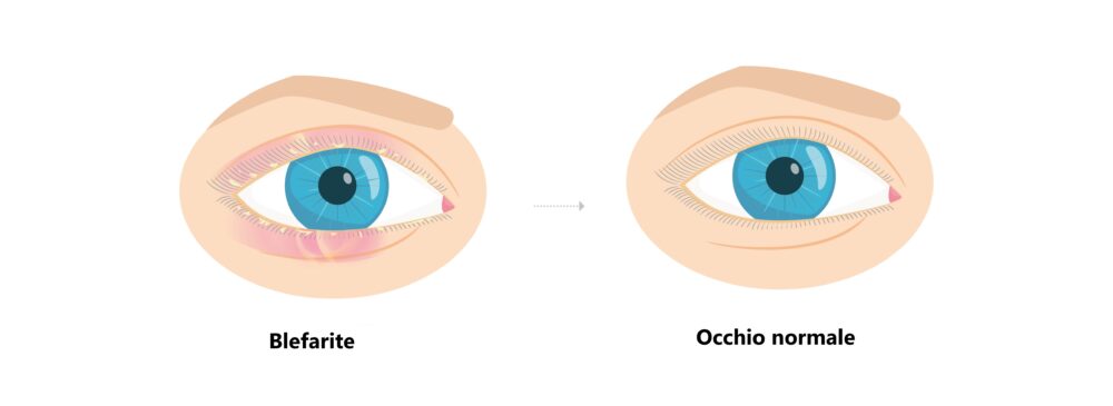 Occhio normale e occhio con blefarite