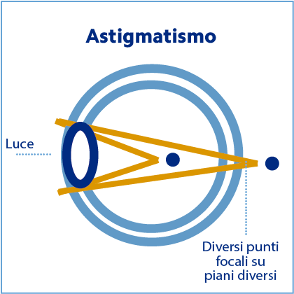 astigmatismo