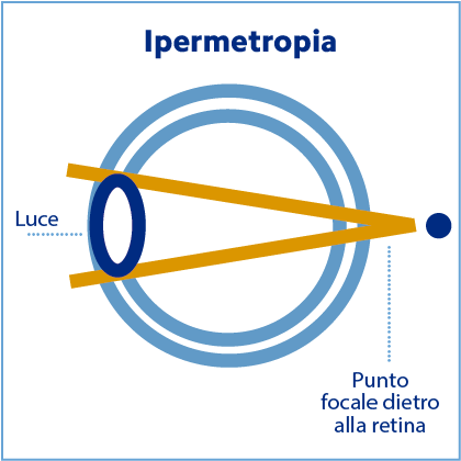 ipermetropia