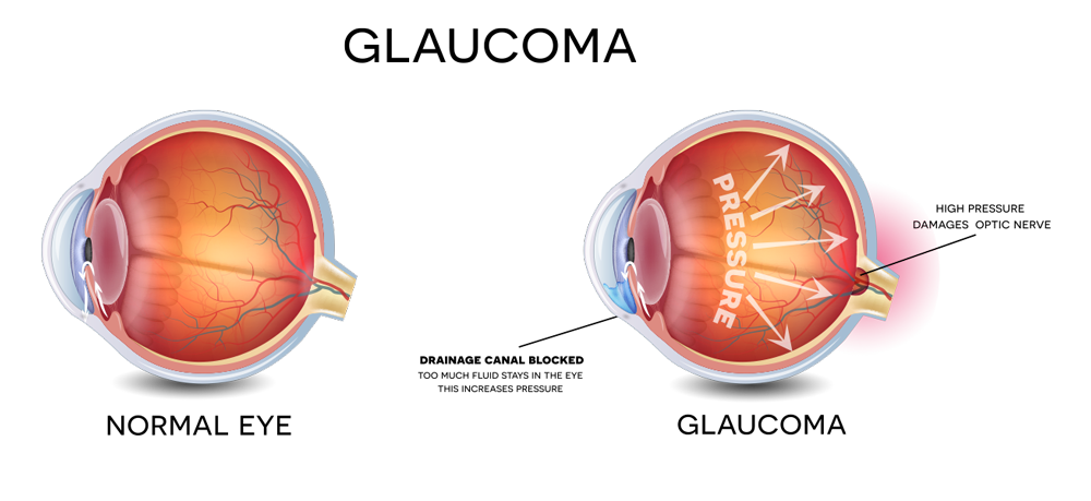 Occhio normale e occhio con glaucoma