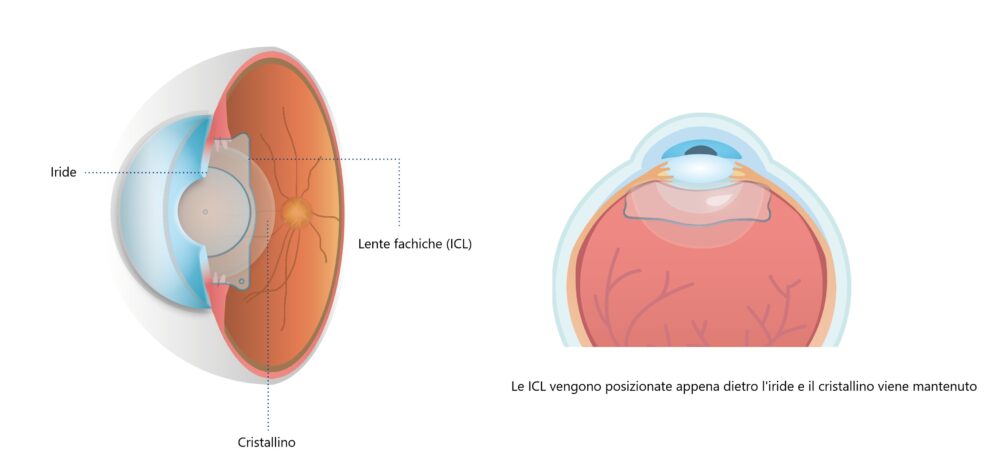 lente fachiche ICL