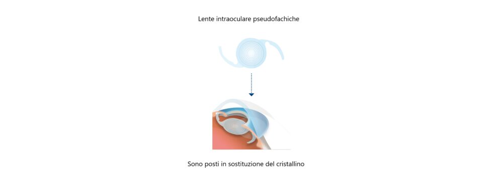 Lenti intraoculari pseudofachiche