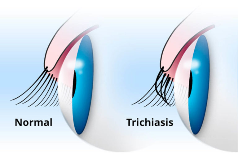 Occhio normale e occhio con trichiasi