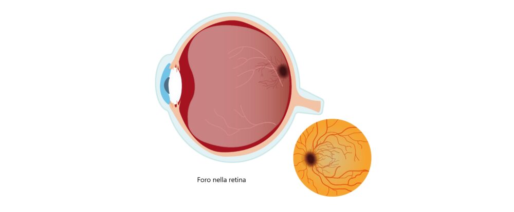 Foro nella retina