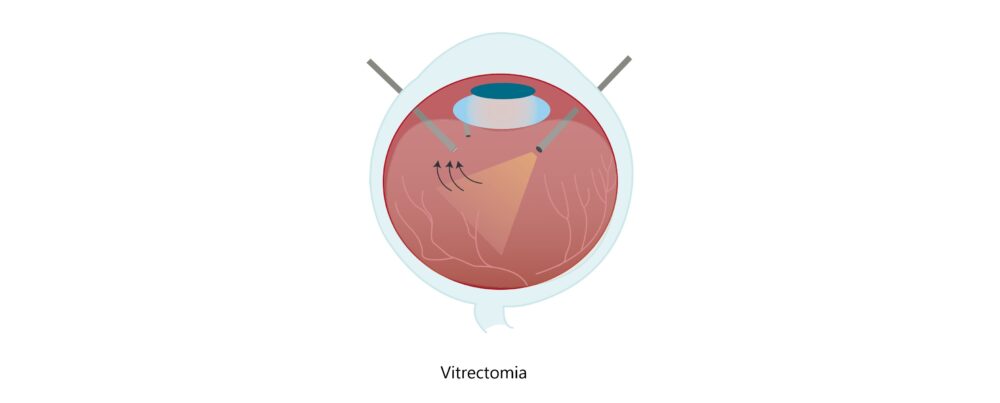 Immagine di Vitrectomia occhio