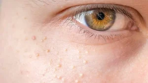 Siringoma: cos'è?