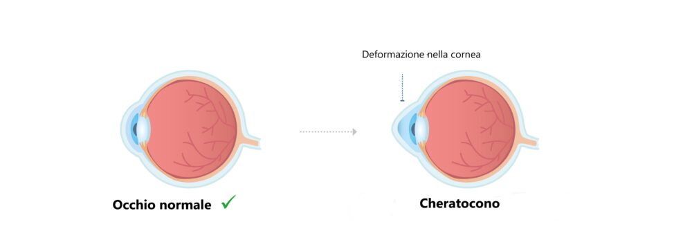 Occhio normale e occhio con cheratocono