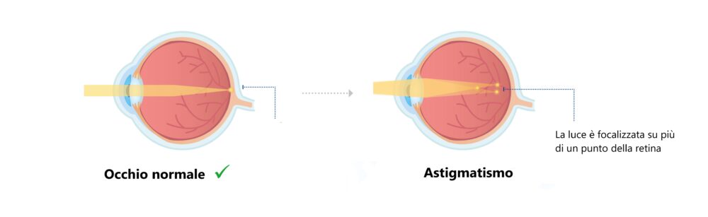 Occhio normale e occhio con astigmatismo