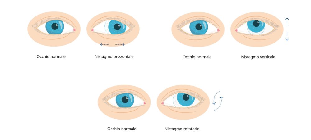 Occhio normale e occhio con nistagmo