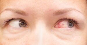 healthy and irritated eye