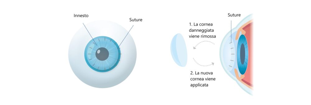 Cornea cheratoconica come si opera