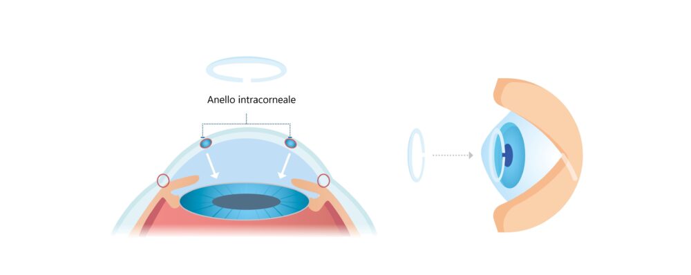 Anello intracorneale