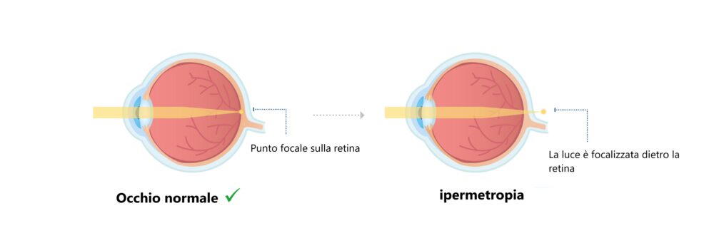 Occhio normale e occhio con ipermetropia