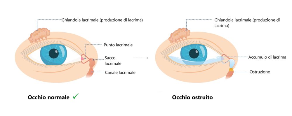 Occhio normale e occhio ostruito 