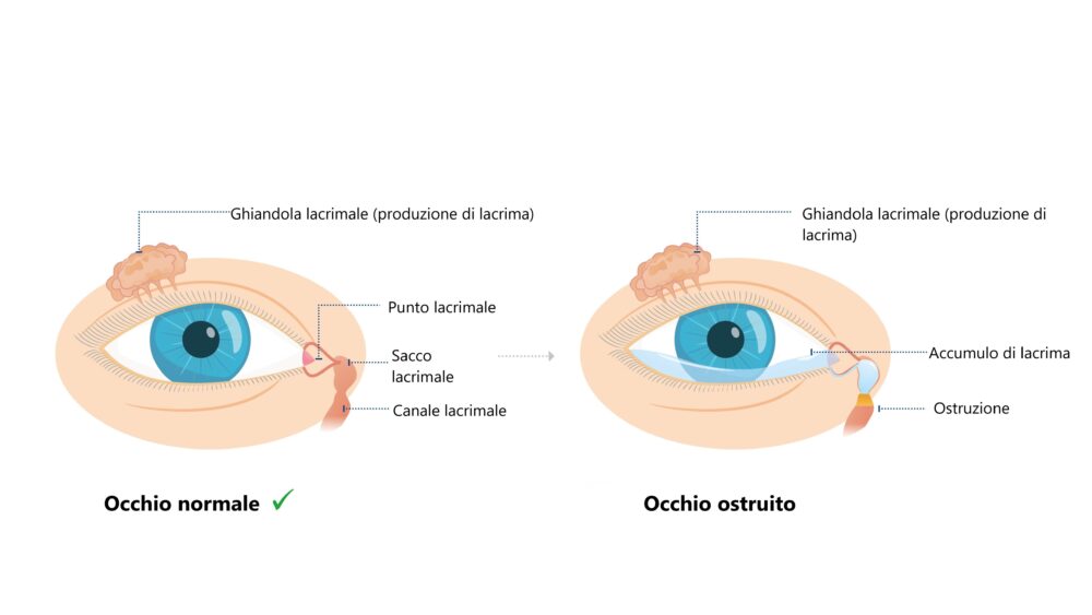 Occhio normale e occhio ostruito 