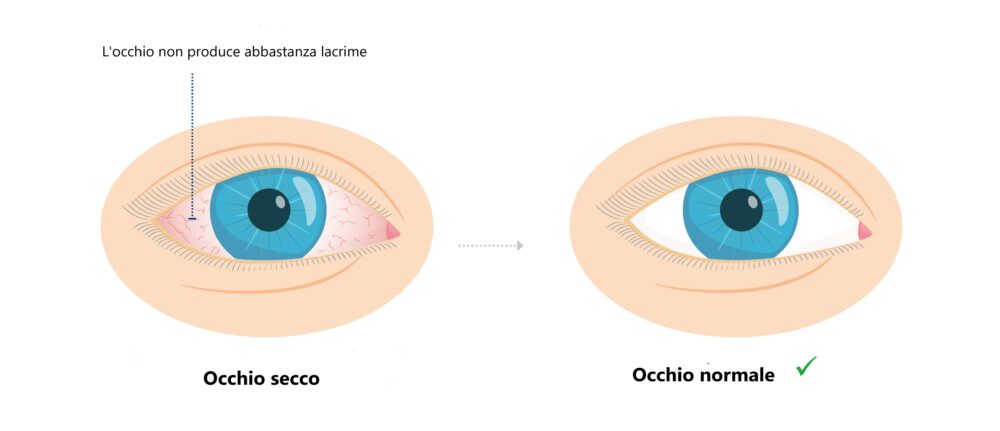 Occhio normale e occhio secco