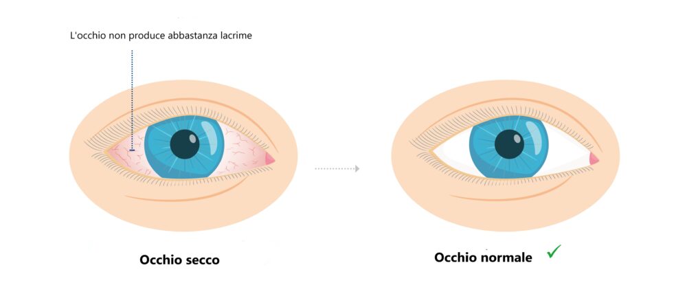 Occhio normale e occhio secco 