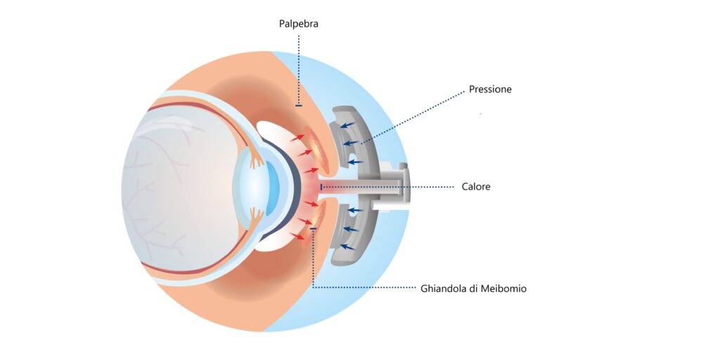 Come si effettua il lipiflow sull'occhio