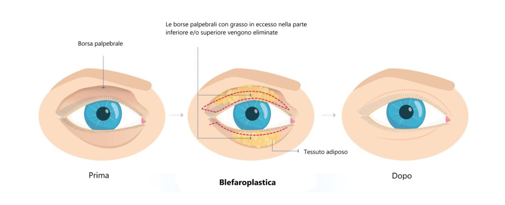 Occhio prima e dopo la blefaroplastica