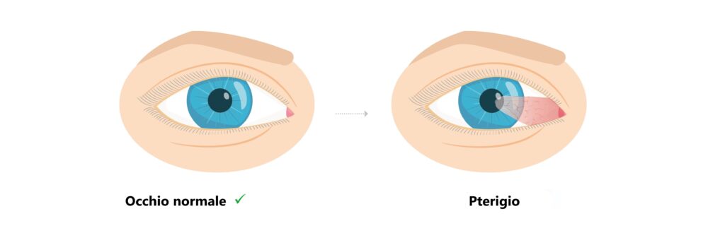 Occhio normale e occhio con pterigio