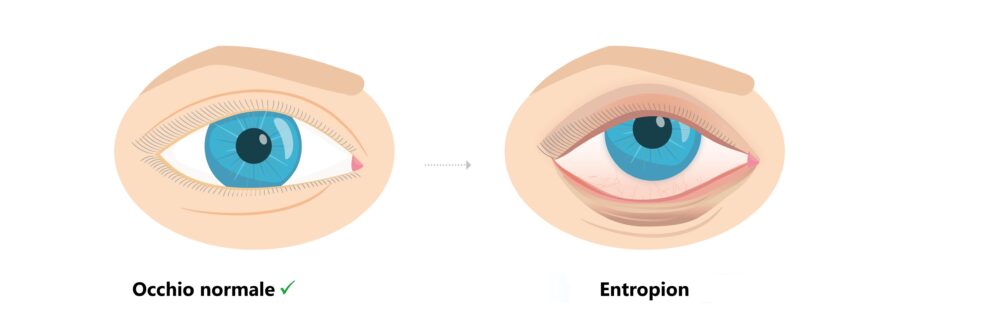 Occhio normale e occhio con Entropion