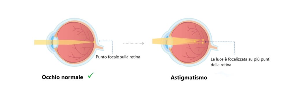 Occhio normale e occhio con astigmatismo