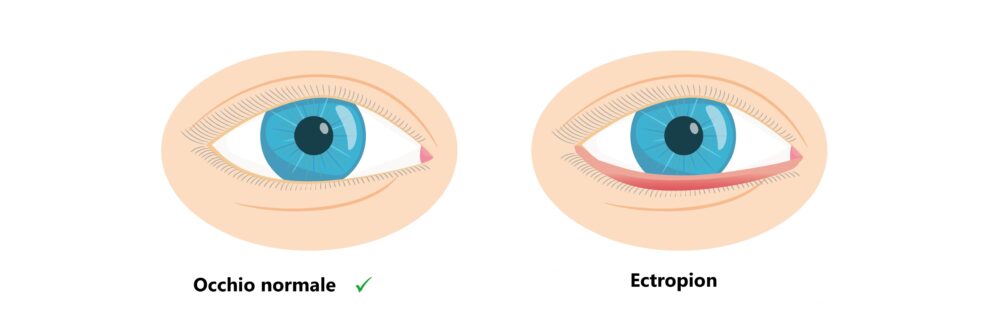 ectropion