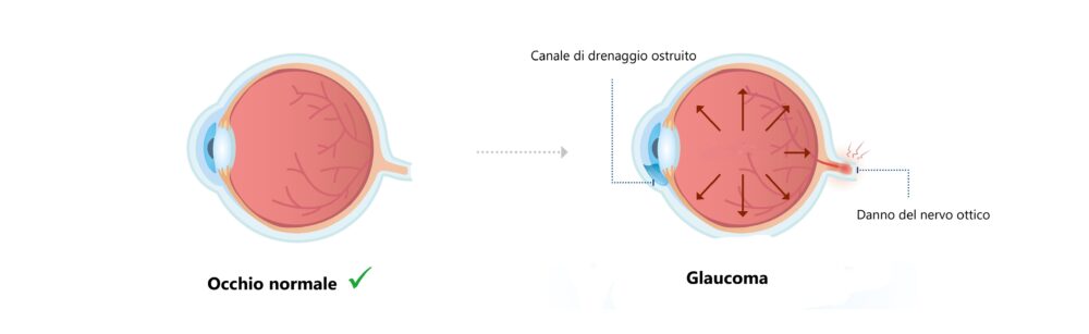 Occhio normale e occhio con glaucoma