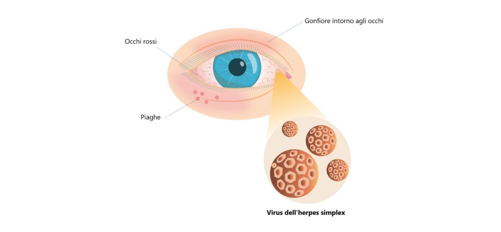 Occhio con herpes