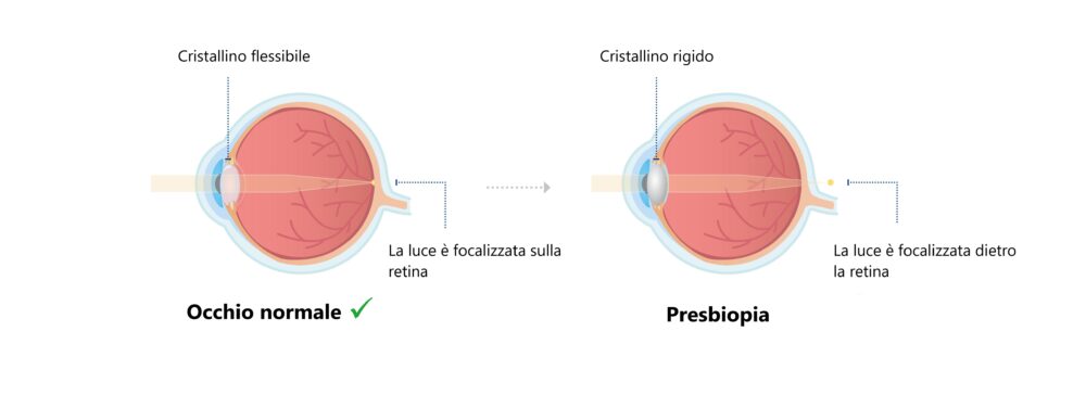 Occhio normale e occhio con presbiopia