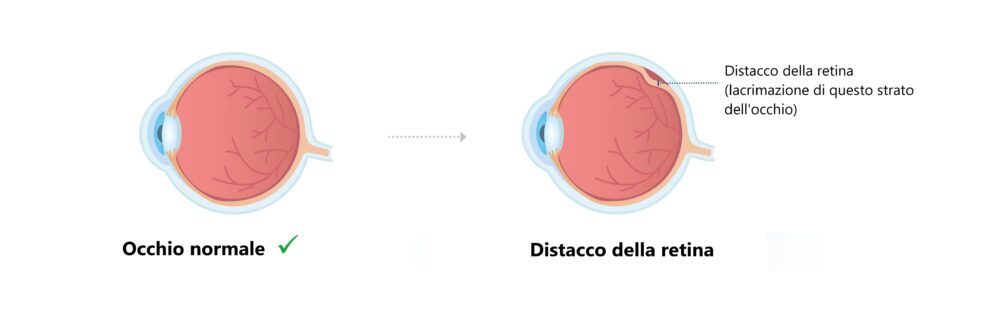 Occhio normale e occhio con distacco della retina