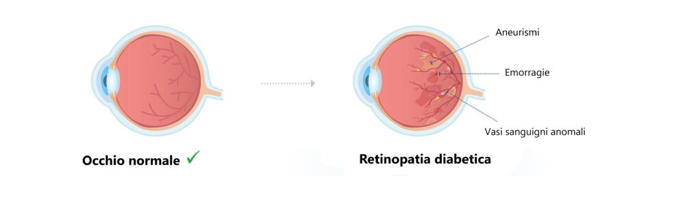 Occhio normale e occhio con retinopatia diabetica