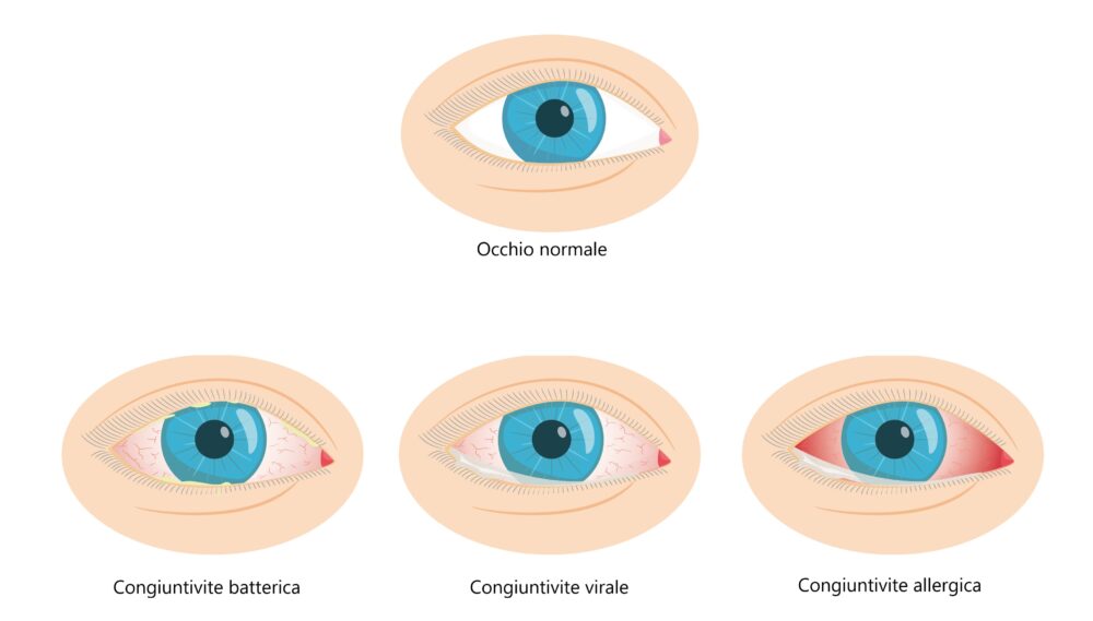 Occhio normale e occhio con congiuntivite batterica, allergica e virale