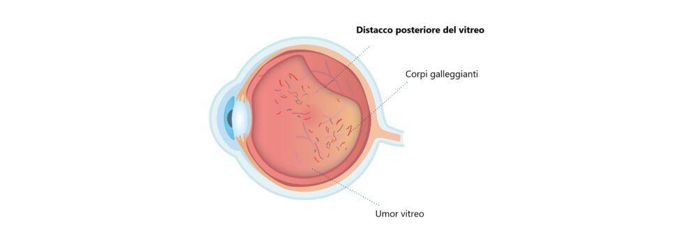 Occhio con distacco posteriore del vitreo 