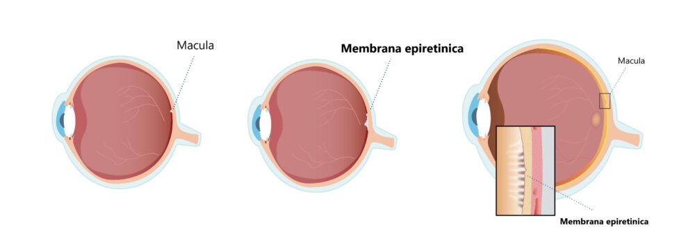 La macula e la membrana epiretinica