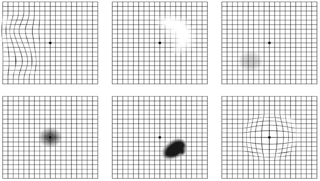 Test di Amsler - Maculopatia