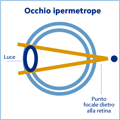 occhio-ipermetrope