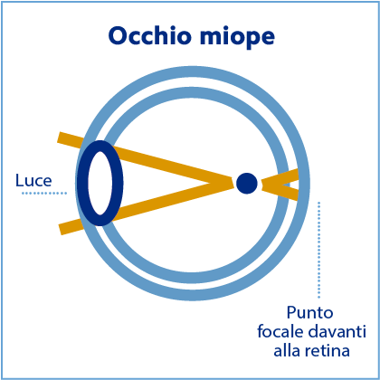 Lenti a contatto sales miopia e astigmatismo insieme
