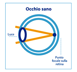 Miopia cos Correzione miopia Clinica Baviera
