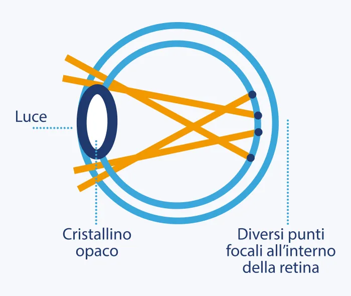 Occhio con Cataratta